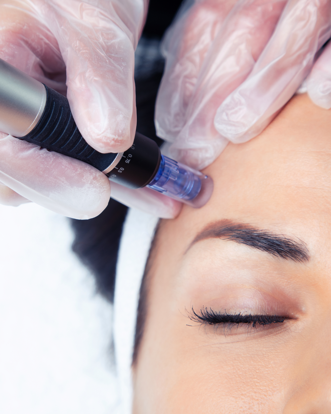 Micro- und Nanoneedling: Needling-Stift mit feiner Nadelkartusche an Schläfe und Stirn bei FlashLine & Beauty in Waidhofen/Ybbs