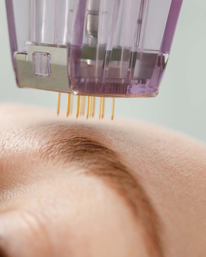 MiQuency RF Needling: goldene Nadeln des Behandlungsaufsatzes über der Stirn bei FlashLine & Beauty in Waidhofen/Ybbs
